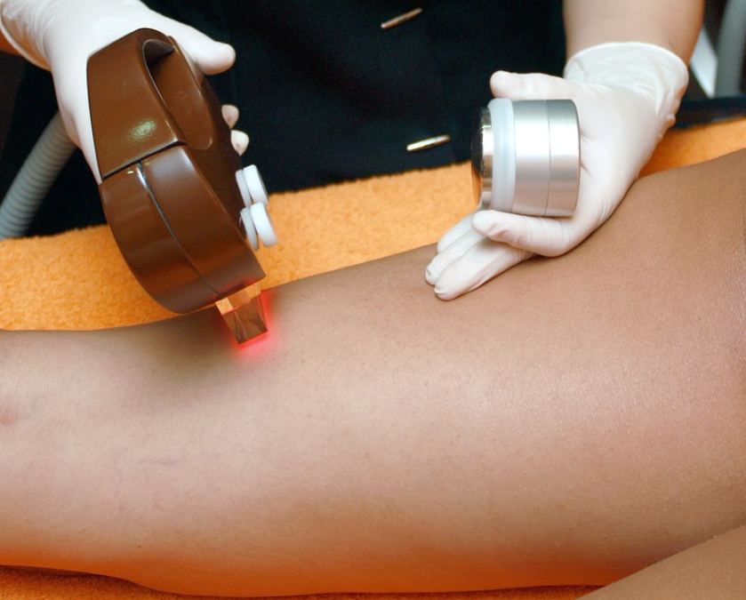 epilation