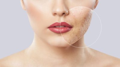 cicatrice-acne