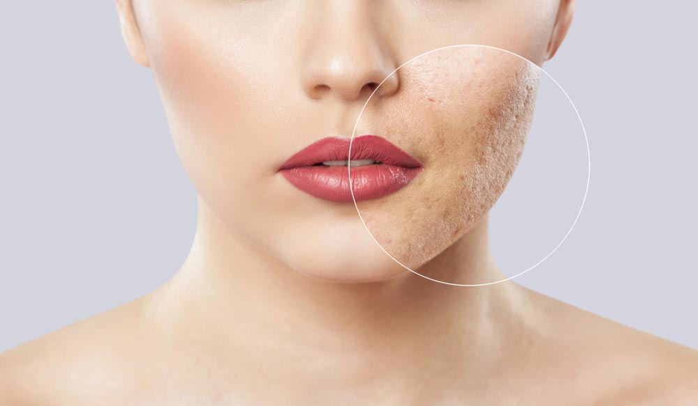cicatrice-acne